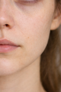 Dry or Irritated Skin